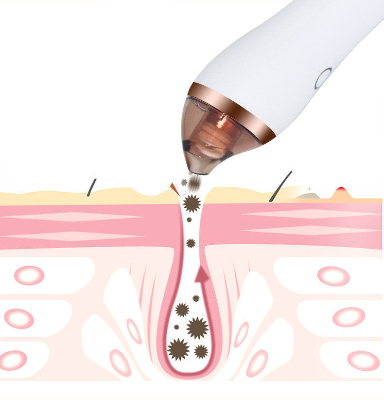 4-in-1 Guasha Cupping Blackhead Remover